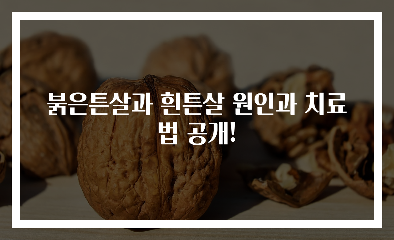 붉은튼살과 흰튼살 원인과 치료법 공개!